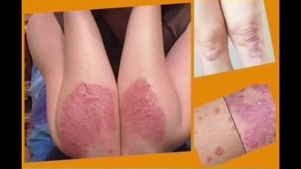 Psoriazis